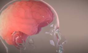 Ο Μασκ ανακοίνωσε την πρώτη επιτυχή εμφύτευση του Telepathy σε εγκέφαλο ασθενή